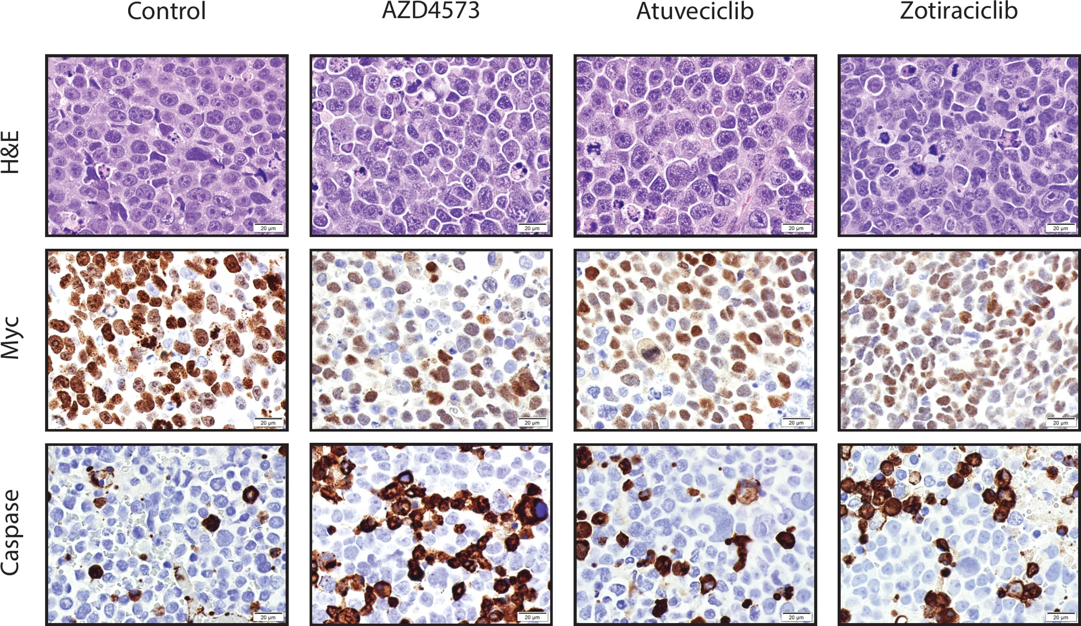 Tumor sections stained three ways &mdash; haematoxylin and eosin, Myc, and caspase &mdash; across a control and three drug treatments, showing loss of Myc staining and increased caspase staining with treatment.