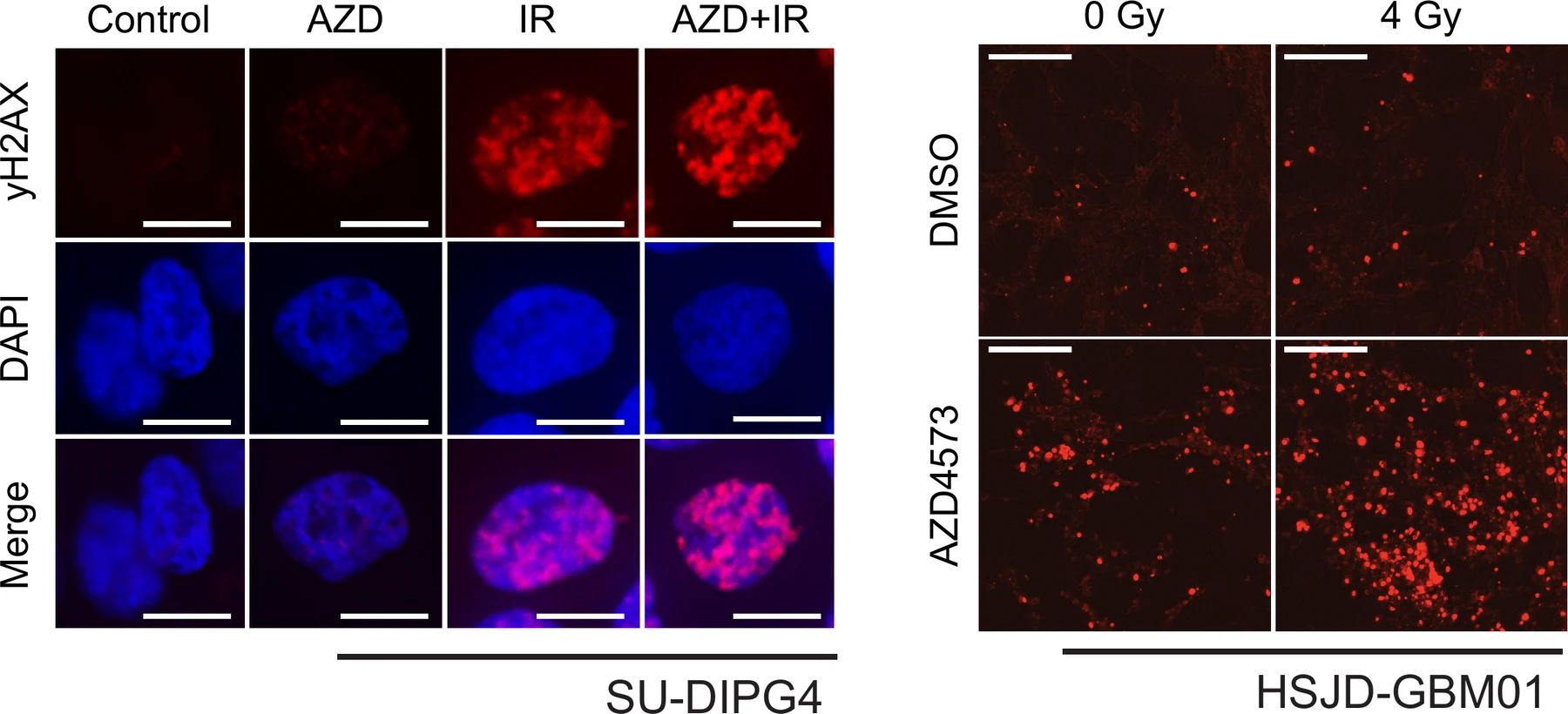 Immunofluorescence panels of cultured glioma cells: gamma-H2AX in red against DAPI-stained nuclei in blue, compared across drug, radiation, and combined treatment, alongside a second cell line at two radiation doses.